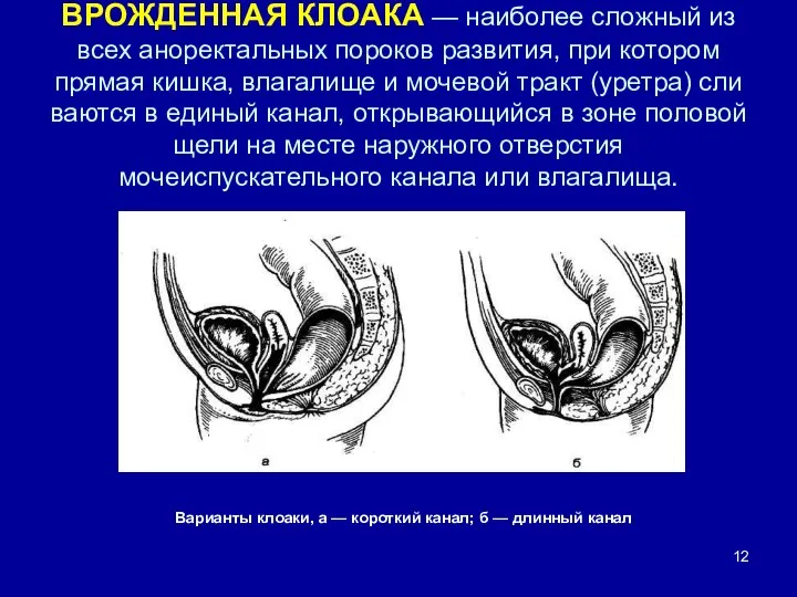 ВРОЖДЕННАЯ КЛОАКА — наиболее сложный из всех аноректальных пороков развития, при