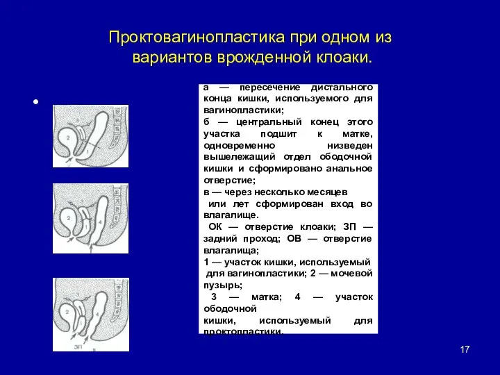 Проктовагинопластика при одном из вариантов врожденной клоаки. а — пересечение дистального