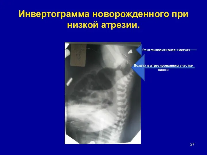 Инвертограмма новорожденного при низкой атрезии. Рентгенпозитивная «метка» Воздух в атрезированном участке кишки