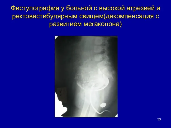 Фистулография у больной с высокой атрезией и ректовестибулярным свищем(декомпенсация с развитием мегаколона)