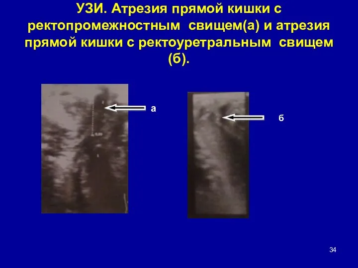 УЗИ. Атрезия прямой кишки с ректопромежностным свищем(а) и атрезия прямой кишки с ректоуретральным свищем(б). а б