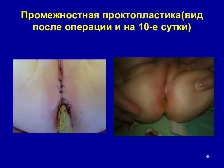 Промежностная проктопластика(вид после операции и на 10-е сутки)