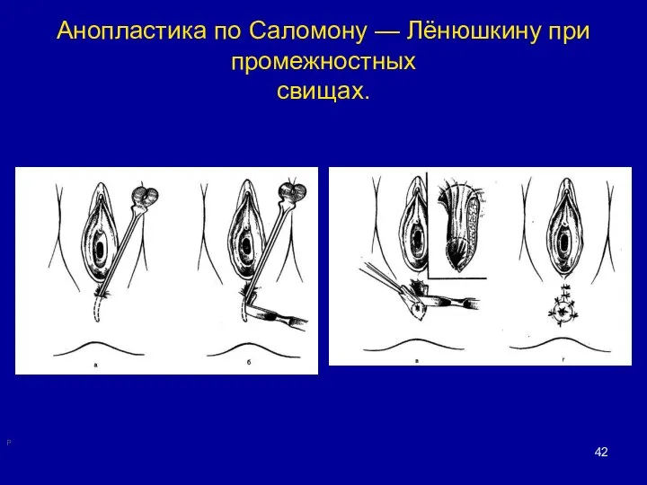 Анопластика по Саломону — Лёнюшкину при промежностных свищах. Р