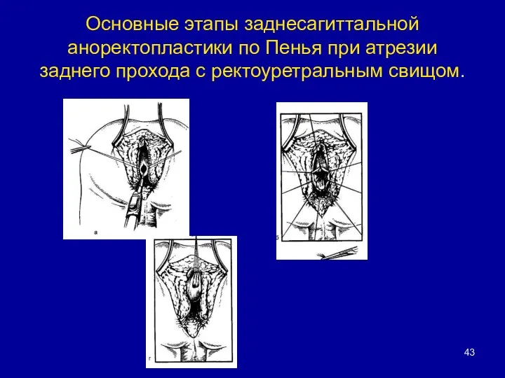 Основные этапы заднесагиттальной аноректопластики по Пенья при атрезии заднего прохода с ректоуретральным свищом.