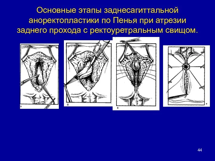 Основные этапы заднесагиттальной аноректопластики по Пенья при атрезии заднего прохода с ректоуретральным свищом.