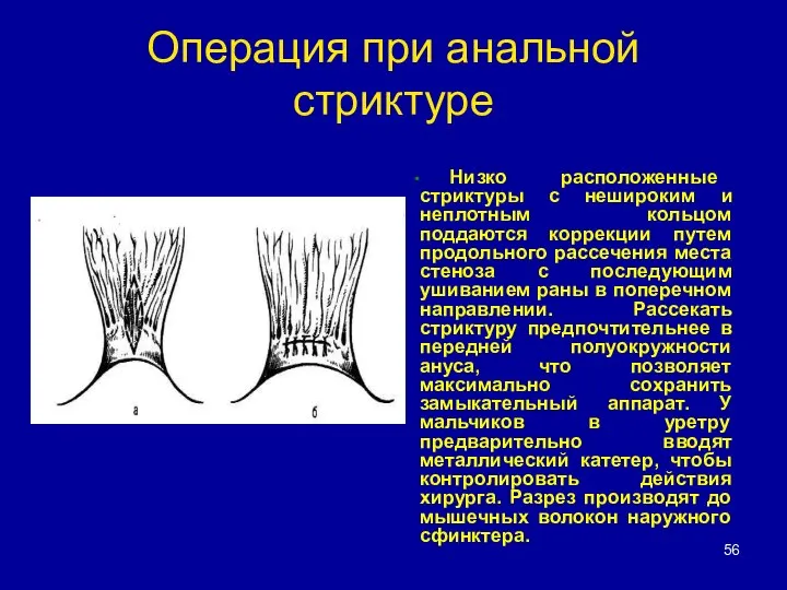 Операция при анальной стриктуре Низко расположенные стриктуры с нешироким и неплотным