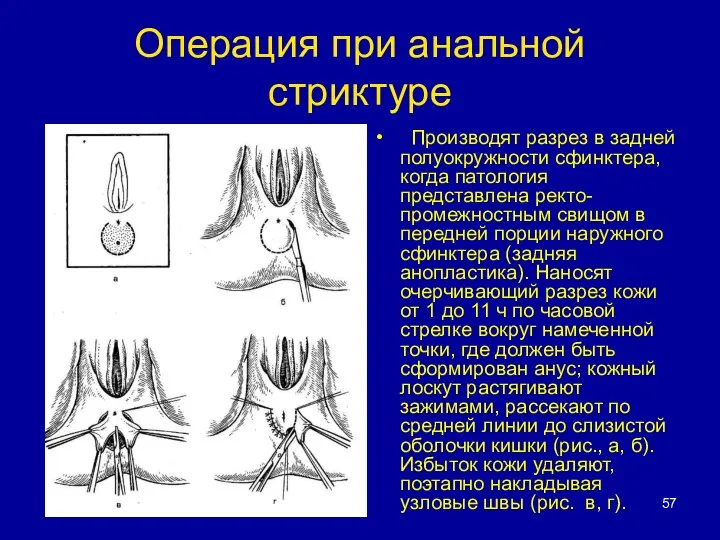 Операция при анальной стриктуре Производят разрез в задней полуокружности сфинктера, когда