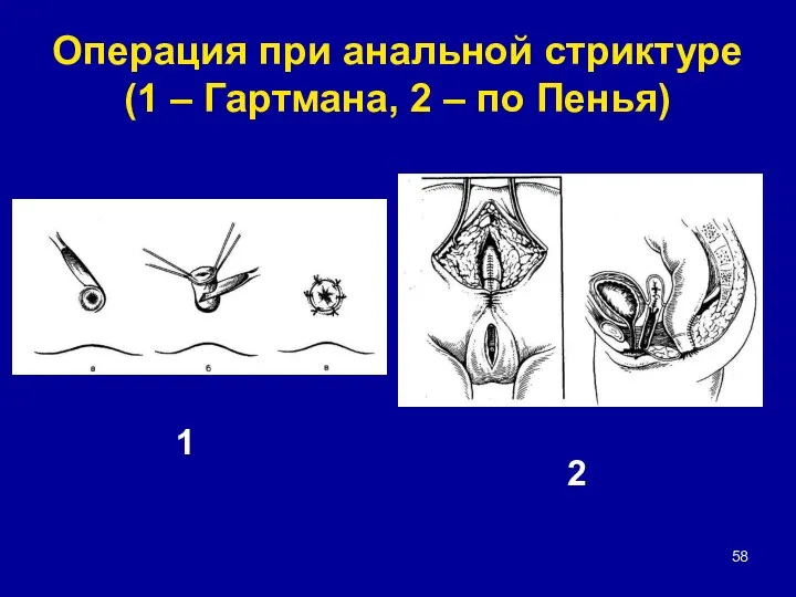 Операция при анальной стриктуре(1 – Гартмана, 2 – по Пенья) 1 2