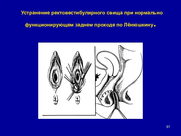 Устранение ректовестибулярного свища при нормально функционирующем заднем проходе по Лёнюшкину.