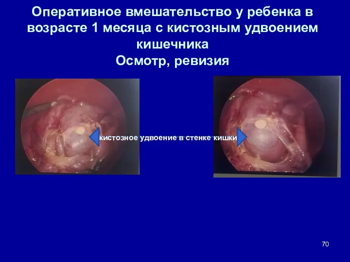 Оперативное вмешательство у ребенка в возрасте 1 месяца с кистозным удвоением