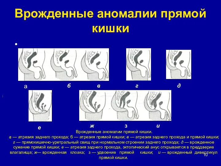 Врожденные аномалии прямой кишки а i Врожденные аномалии прямой кишки. а