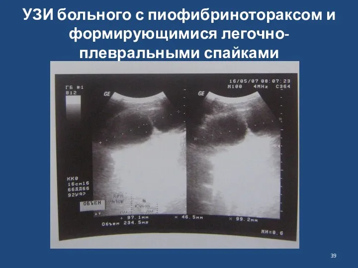 УЗИ больного с пиофибринотораксом и формирующимися легочно-плевральными спайками