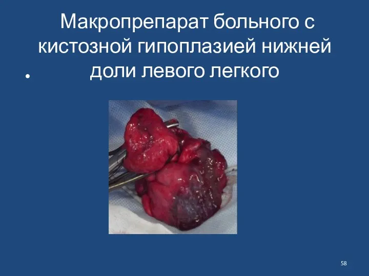 Макропрепарат больного с кистозной гипоплазией нижней доли левого легкого