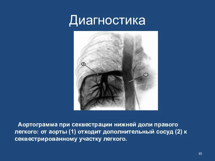 Диагностика Аортограмма при секвестрации нижней доли правого легкого: от аорты (1)