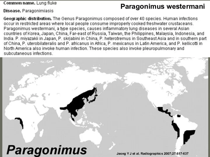 Jeong Y J et al. Radiographics 2007;27:617-637 Paragonimus westermani