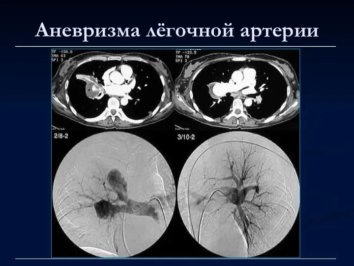 Аневризма лёгочной артерии