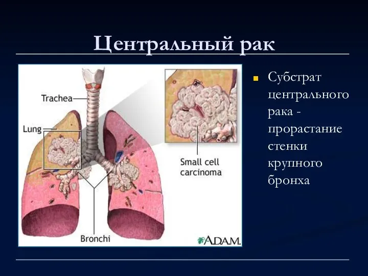 Центральный рак Субстрат центрального рака -прорастание стенки крупного бронха