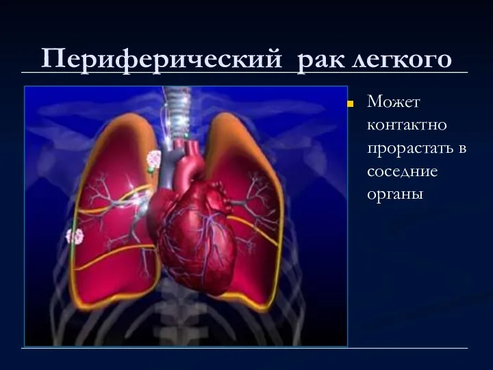 Периферический рак легкого Может контактно прорастать в соседние органы