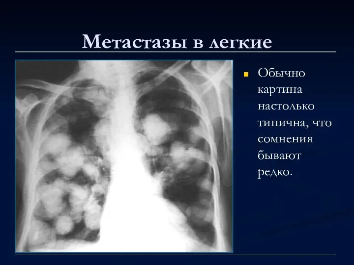 Метастазы в легкие Обычно картина настолько типична, что сомнения бывают редко.