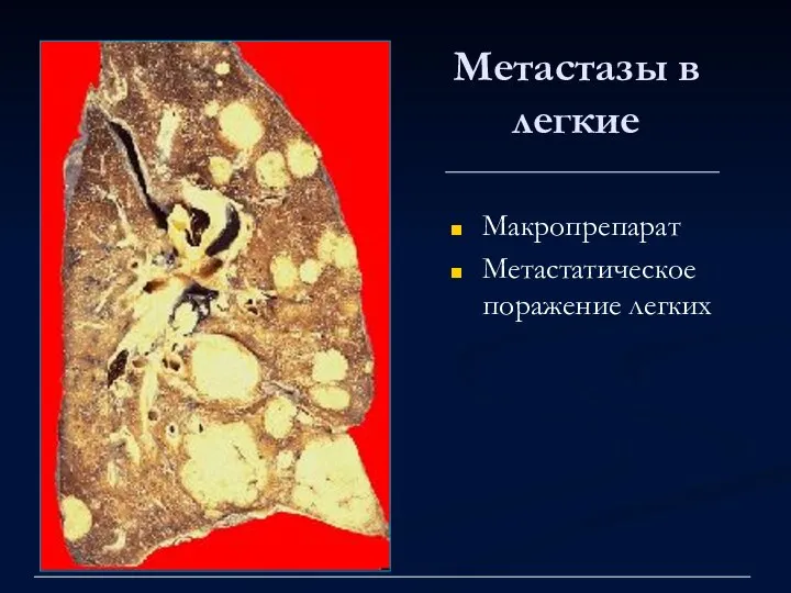 Метастазы в легкие Макропрепарат Метастатическое поражение легких