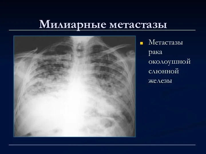 Милиарные метастазы Метастазы рака околоушной слюнной железы