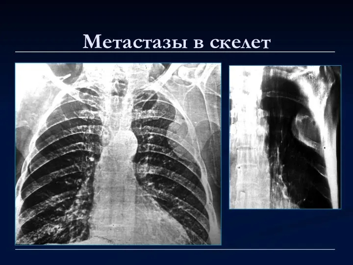 Метастазы в скелет