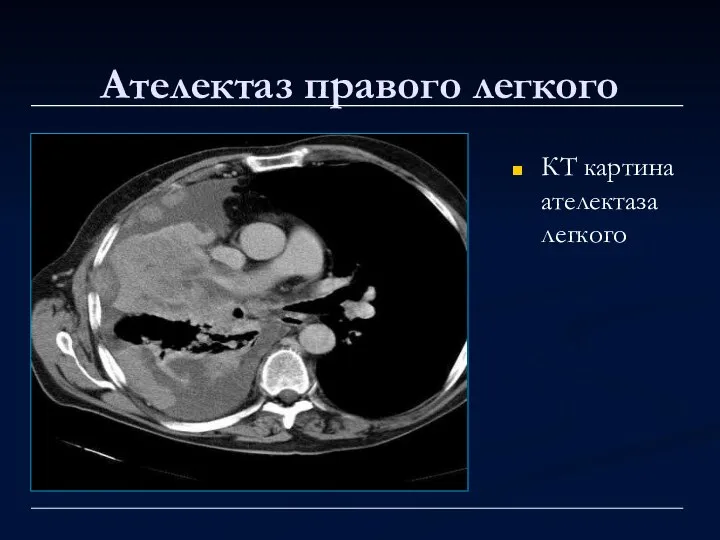 Ателектаз правого легкого КТ картина ателектаза легкого