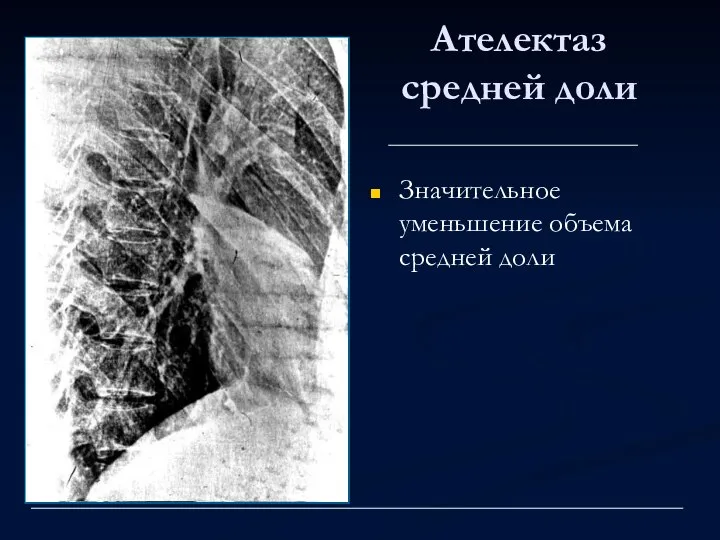 Ателектаз средней доли Значительное уменьшение объема средней доли