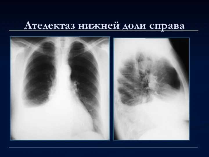 Ателектаз нижней доли справа