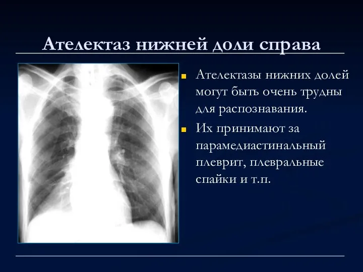 Ателектаз нижней доли справа Ателектазы нижних долей могут быть очень трудны