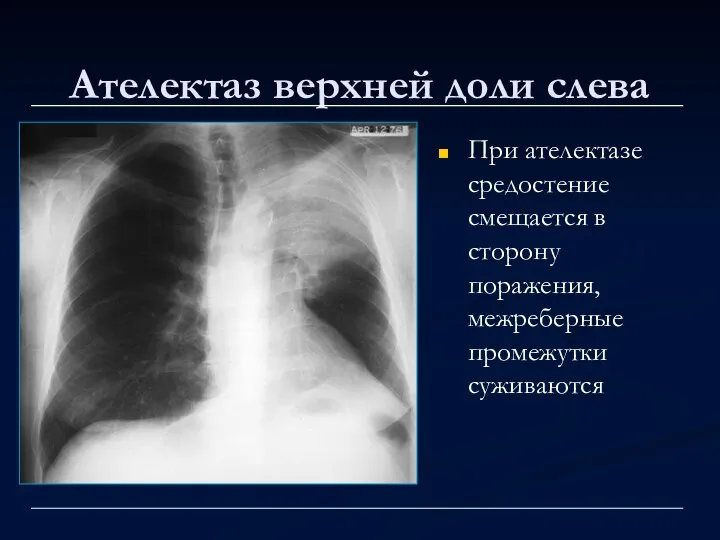 Ателектаз верхней доли слева При ателектазе средостение смещается в сторону поражения, межреберные промежутки суживаются