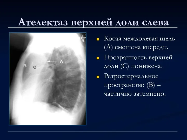 Ателектаз верхней доли слева Косая междолевая щель (А) смещена кпереди. Прозрачность