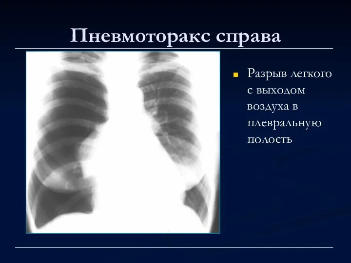 Пневмоторакс справа Разрыв легкого с выходом воздуха в плевральную полость