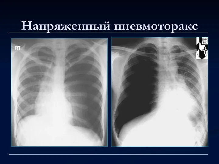 Напряженный пневмоторакс