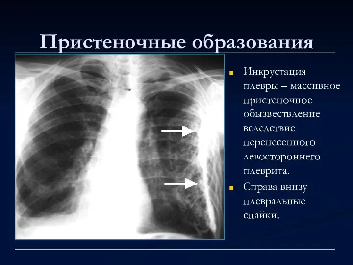 Пристеночные образования Инкрустация плевры – массивное пристеночное обызвествление вследствие перенесенного левостороннего плеврита. Справа внизу плевральные спайки.