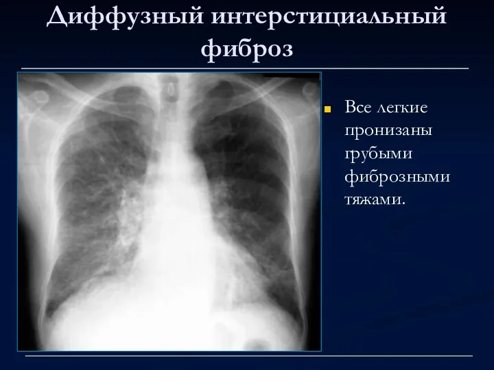 Диффузный интерстициальный фиброз Все легкие пронизаны грубыми фиброзными тяжами.