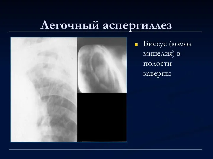 Легочный аспергиллез Биссус (комок мицелия) в полости каверны