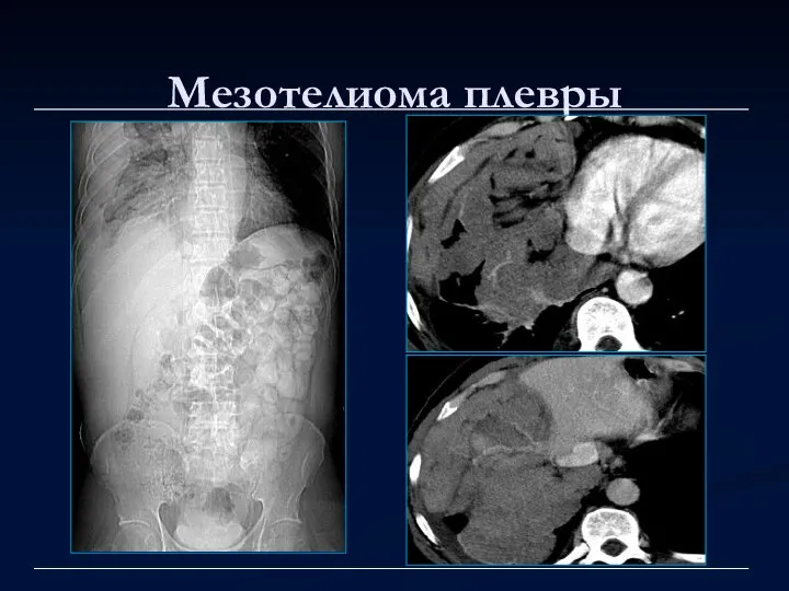 Мезотелиома плевры