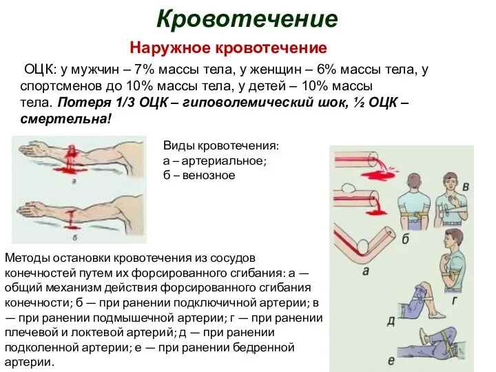 Кровотечение Виды кровотечения: а – артериальное; б – венозное Методы остановки