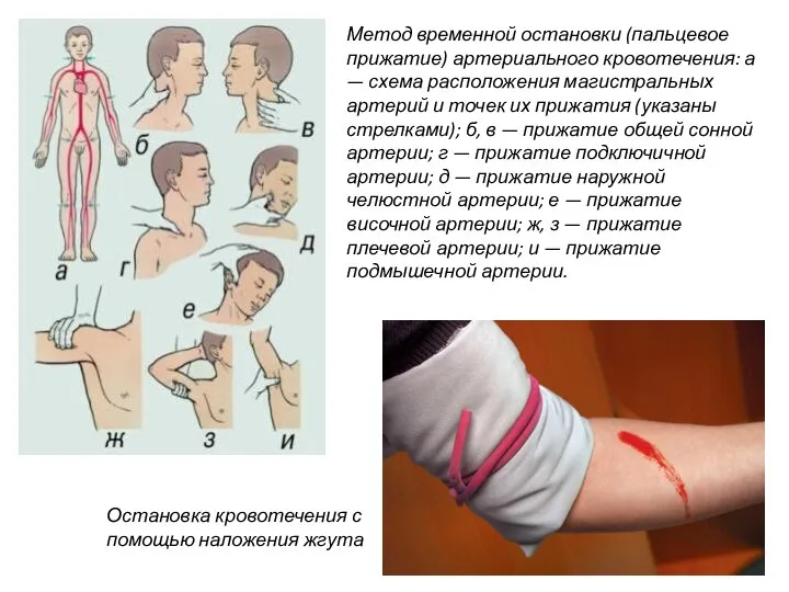 артерии; и — прижатие подмышечной артерии. Метод временной остановки (пальцевое прижатие)