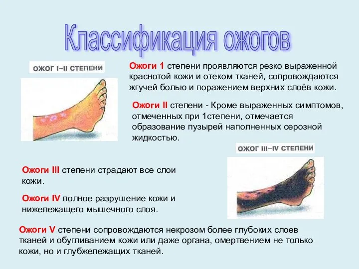 Ожоги 1 степени проявляются резко выраженной краснотой кожи и отеком тканей,