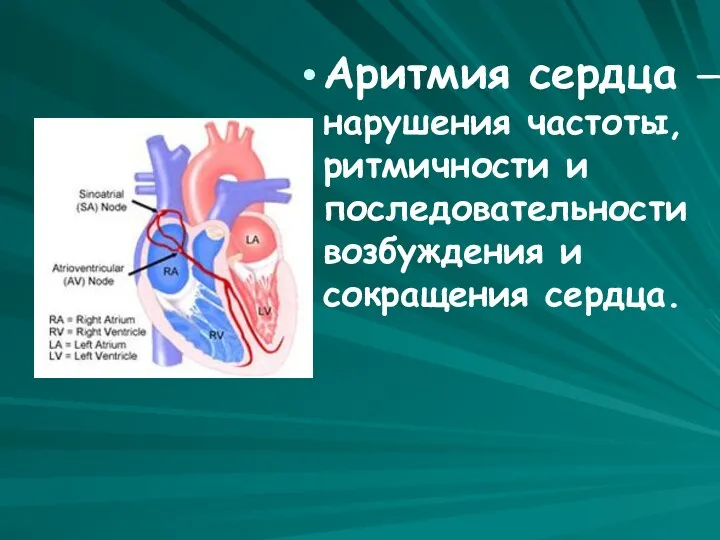 Аритмия сердца — нарушения частоты, ритмичности и последовательности возбуждения и сокращения сердца.