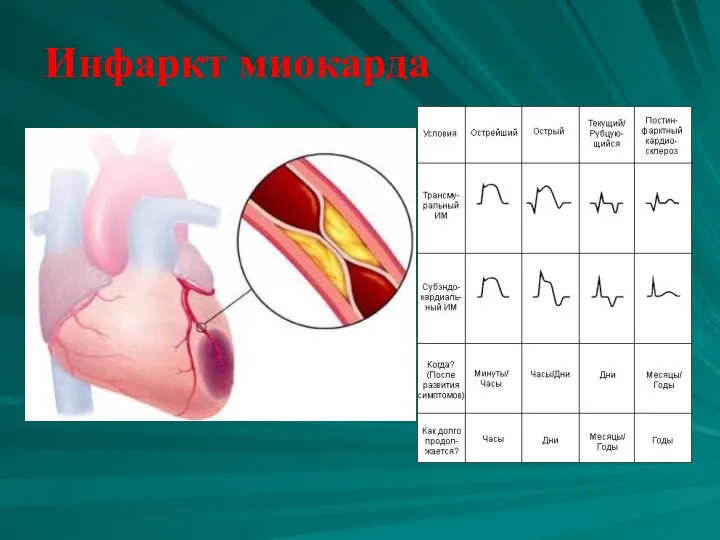 Инфаркт миокарда