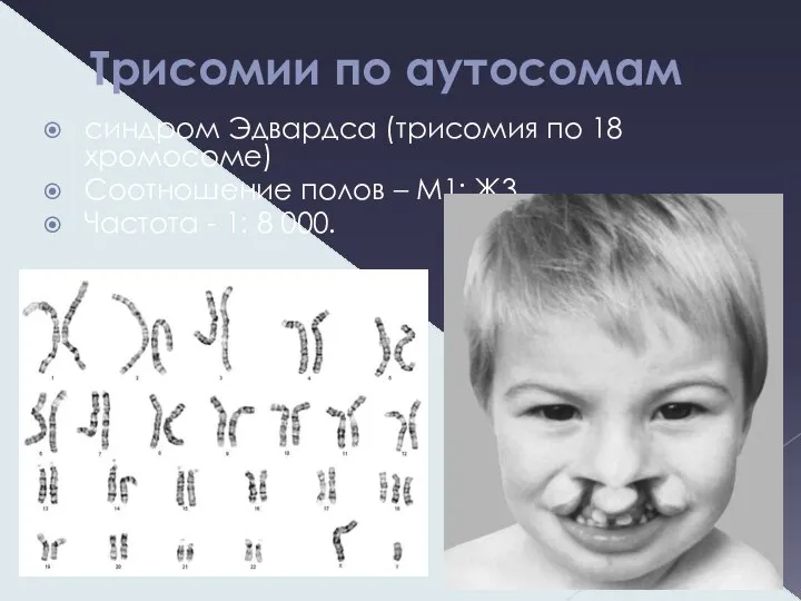 Трисомии по аутосомам синдром Эдвардса (трисомия по 18 хромосоме) Соотношение полов