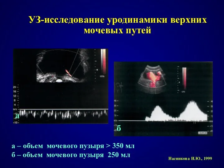 УЗ-исследование уродинамики верхних мочевых путей Насникова И.Ю., 1999 а – объем
