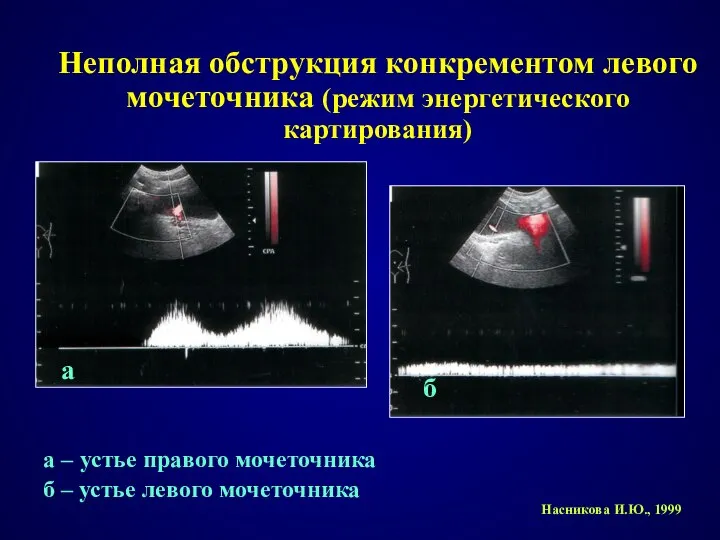 Неполная обструкция конкрементом левого мочеточника (режим энергетического картирования) Насникова И.Ю., 1999