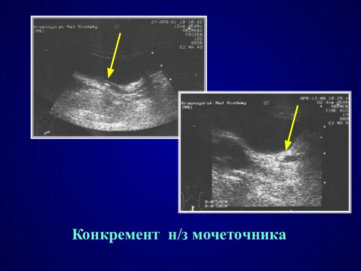 Конкремент н/з мочеточника