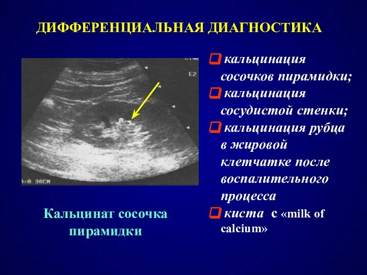 Кальцинат сосочка пирамидки кальцинация сосочков пирамидки; кальцинация сосудистой стенки; кальцинация рубца