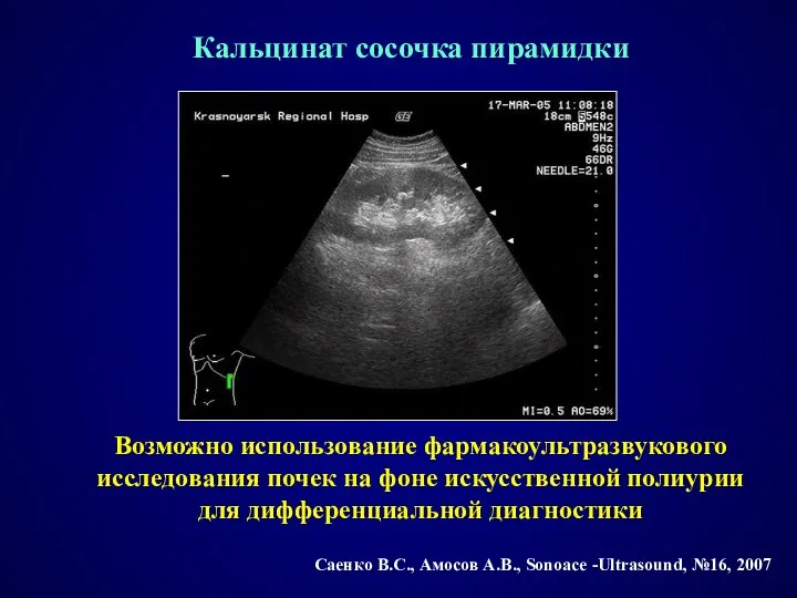 Кальцинат сосочка пирамидки Возможно использование фармакоультразвукового исследования почек на фоне искусственной