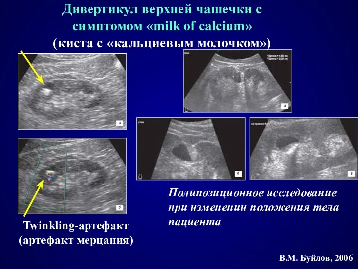 Дивертикул верхней чашечки с симптомом «milk of calcium» (киста с «кальциевым